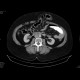 Ventral hernia, herniation of transverse colon: CT - Computed tomography